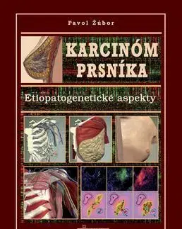 Medicína - ostatné Karcinóm prsníka - Pavol Žúbor