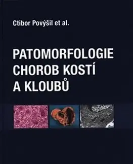 Medicína - ostatné Patomorfologie chorob kostí a kloubů - Ctibor Povýšil