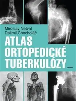 Medicína - ostatné Atlas ortopedické tuberkulózy - Dalimil Chocholac