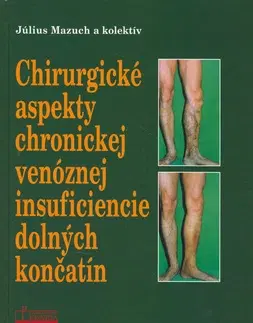 Medicína - ostatné Chirurgické aspekty chronickej venóznej insuficiencie dolných končatín - Július Mazúch