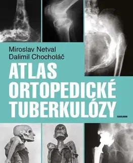 Medicína - ostatné Atlas ortopedické tuberkulózy - Dalimil Chocholac,Miroslav Netval