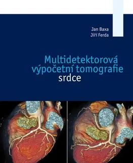 Medicína - ostatné Multidetektorová výpočetní tomografie srdce - Jan Baxa,Jiří Ferda