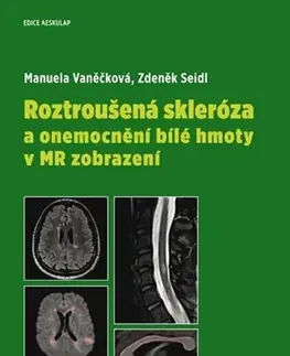 Medicína - ostatné Roztroušená skleróza a onemocnění bílé hmoty v MR zobrazení - Zdeněk Seidl,Manuela Vaněčková