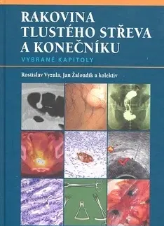 Medicína - ostatné Rakovina tlustého střeva a konečníku - Rostislav Vyzula