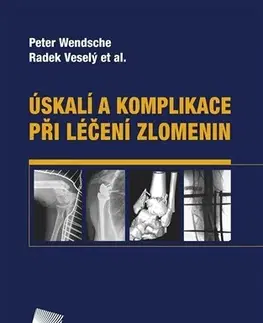 Chirurgia, ortopédia, traumatológia Úskalí a komplikace při léčení zlomenin - Peter Wendsche,Radek Veselý