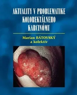 Onkológia Aktuality v problematike kolorektálneho karcinómu - Kolektív autorov,Marián Bátovský
