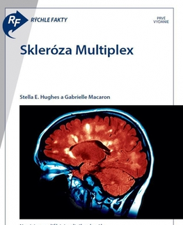 Medicína - ostatné Rýchle fakty : Skleróza multiplex - Kolektív autorov