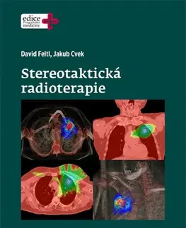 Medicína - ostatné Stereotaktická radioterapie - Feltl David,Jakub Cvek