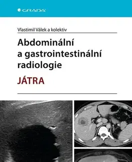Medicína - ostatné Abdominální a gastrointestinální radiologie - Játra - Vlastimil Válek,Kolektív autorov