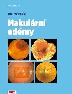 Medicína - ostatné Makulární edémy - Ernest Jan