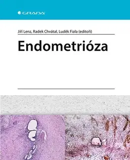 Medicína - ostatné Endometrióza - Jiří Lenz,Radek Chvátal,Luděk Fiala