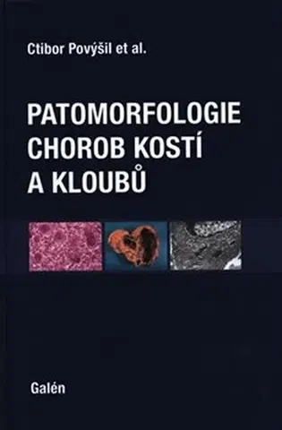 Medicína - ostatné Patomorfologie chorob kostí a kloubů - Ctibor Povýšil