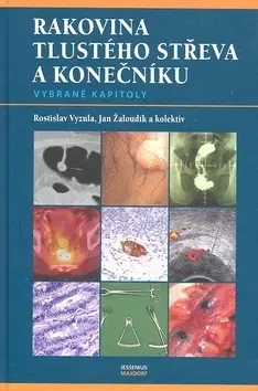 Medicína - ostatné Rakovina tlustého střeva a konečníku - Rostislav Vyzula