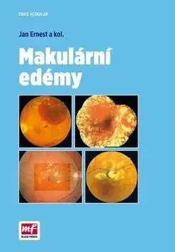 Medicína - ostatné Makulární edémy - Ernest Jan